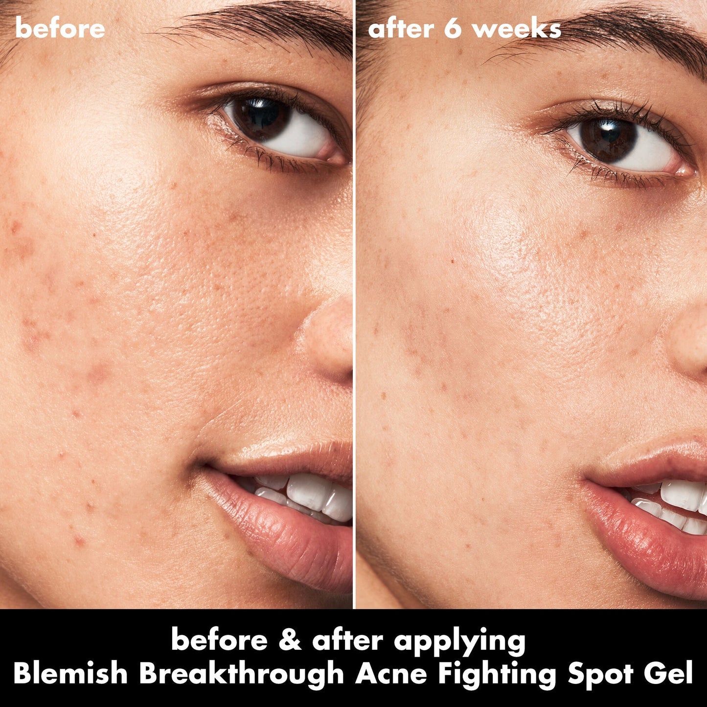 blemish-breakthrough-acne-fighting-spot-gel-o9 0326_EDU_BB_SpotGel_BA_ISABELLA.jpg