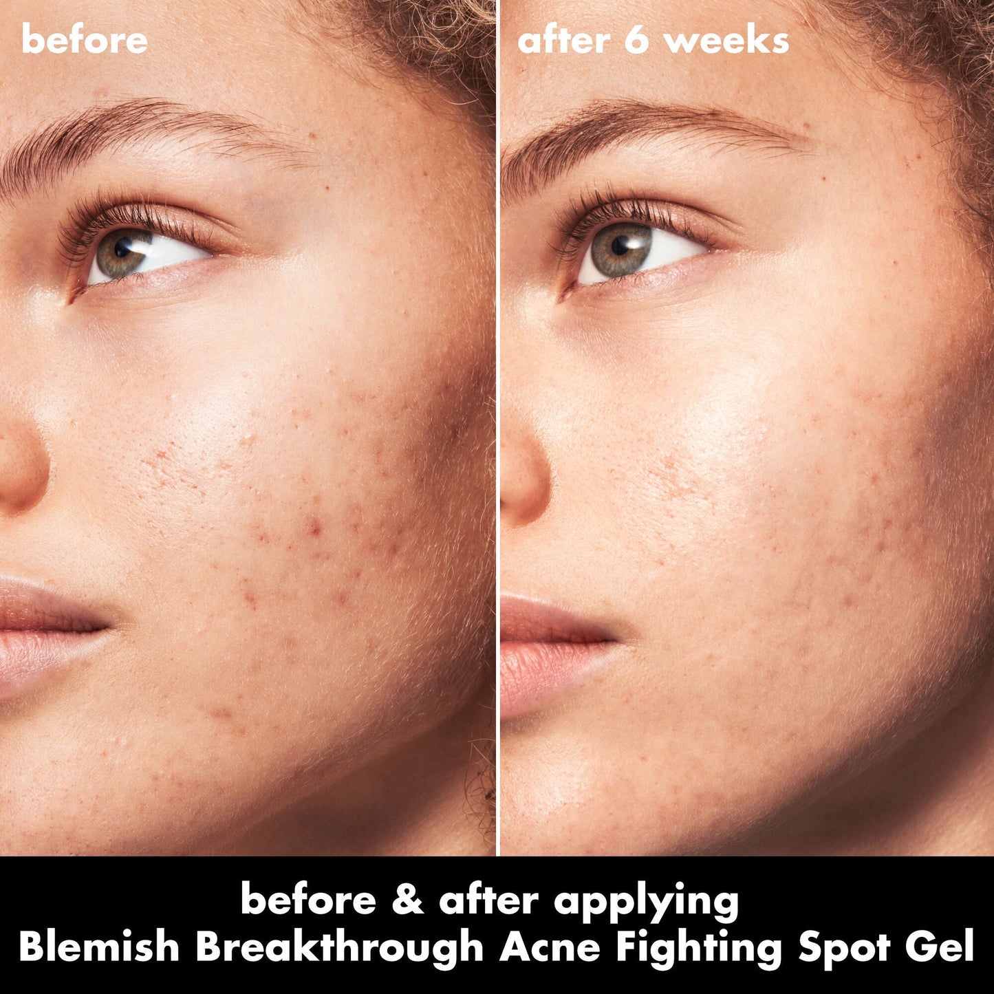blemish-breakthrough-acne-fighting-spot-gel-o9 0326_EDU_BB_SpotGel_BA_MARLEY.jpg