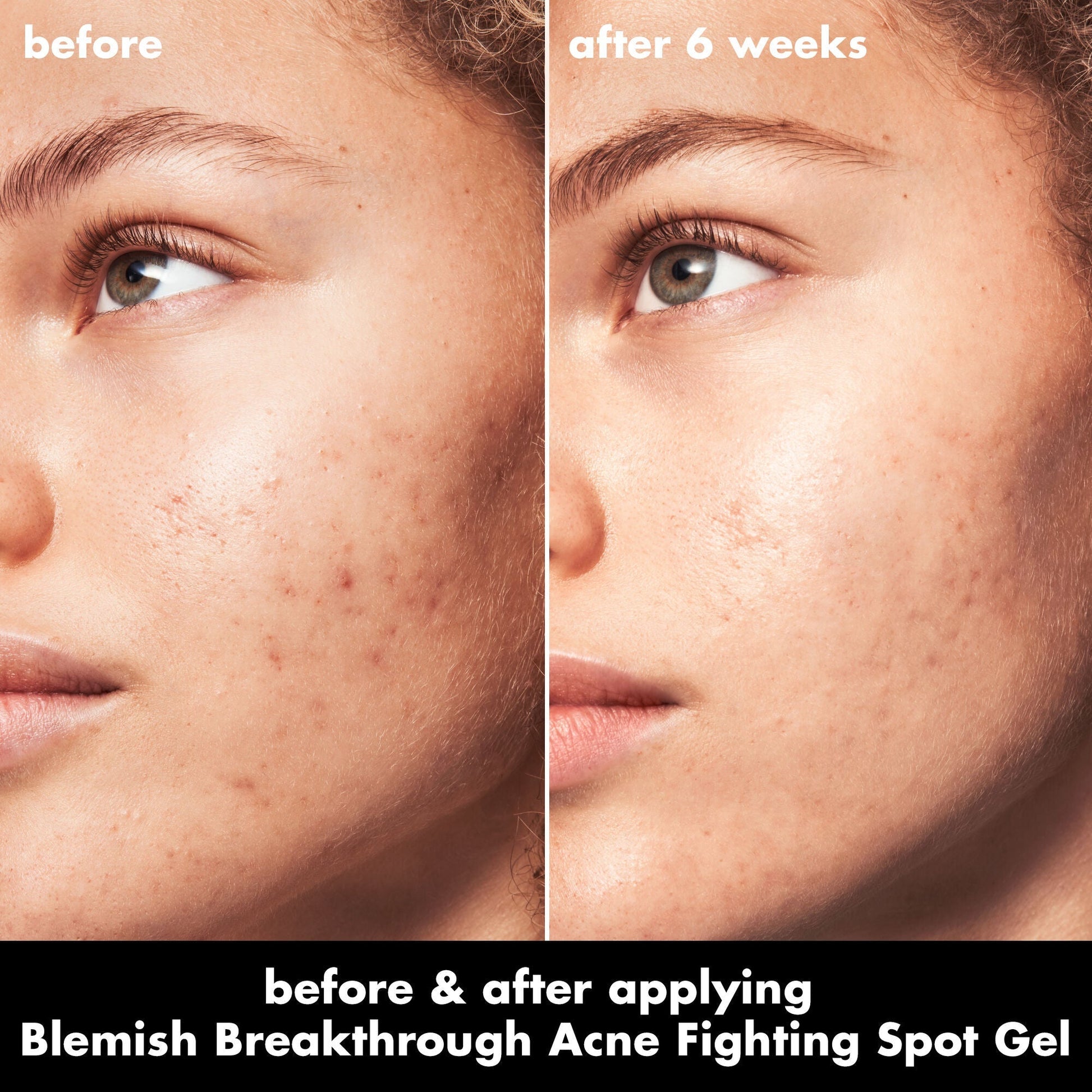 blemish-breakthrough-acne-fighting-spot-gel-o9 0326_EDU_BB_SpotGel_BA_MARLEY.jpg