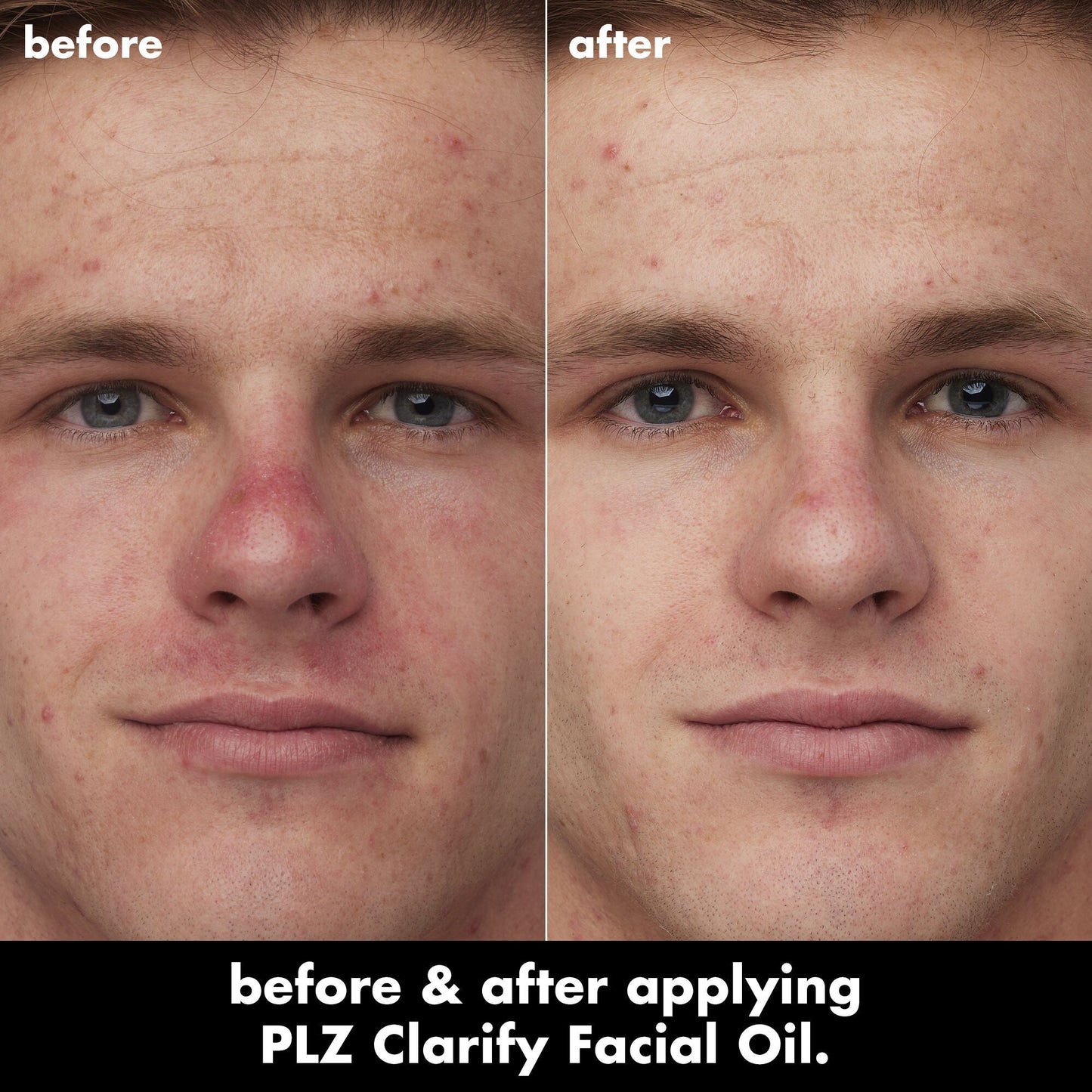 plz-clarify-facial-oil-h9 0326_EDU_PlzClarify_BA_Caleb.jpg
