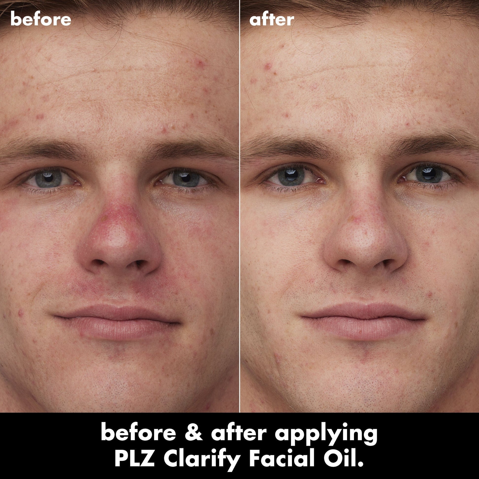 plz-clarify-facial-oil-h9 0326_EDU_PlzClarify_BA_Caleb.jpg