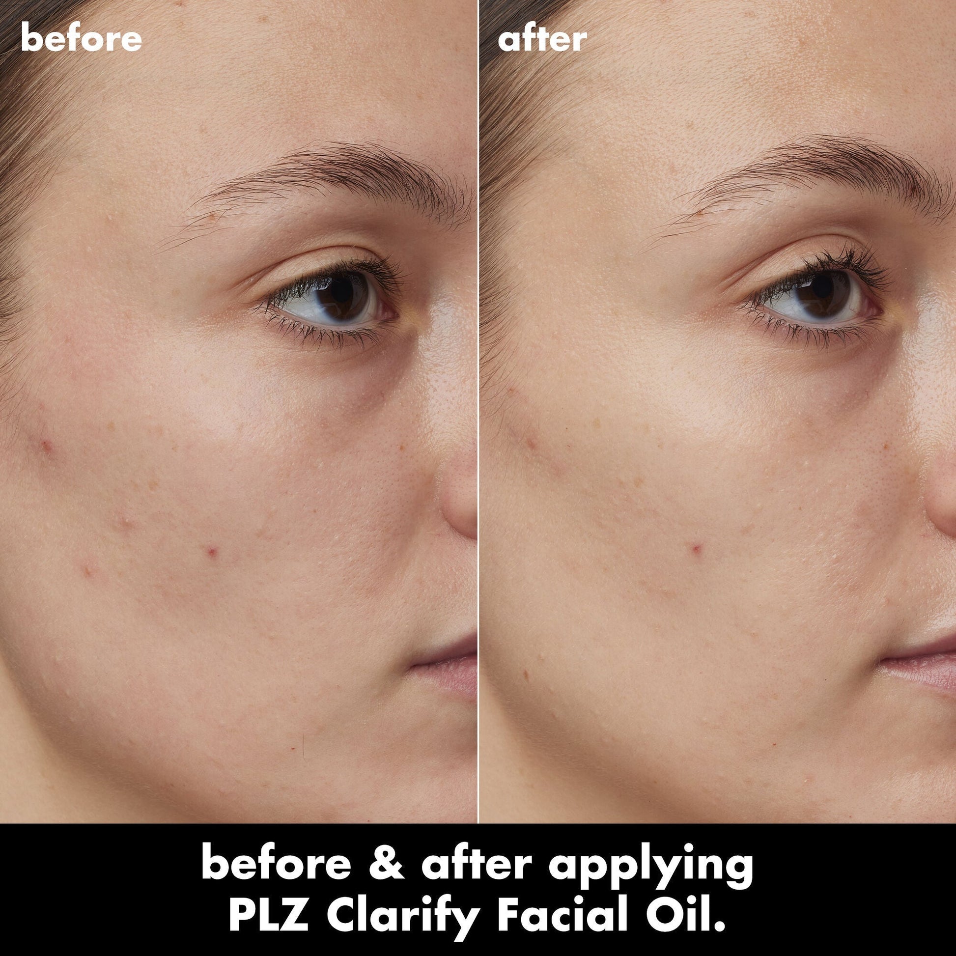 plz-clarify-facial-oil-h9 0326_EDU_PlzClarify_BA_Kelly.jpg