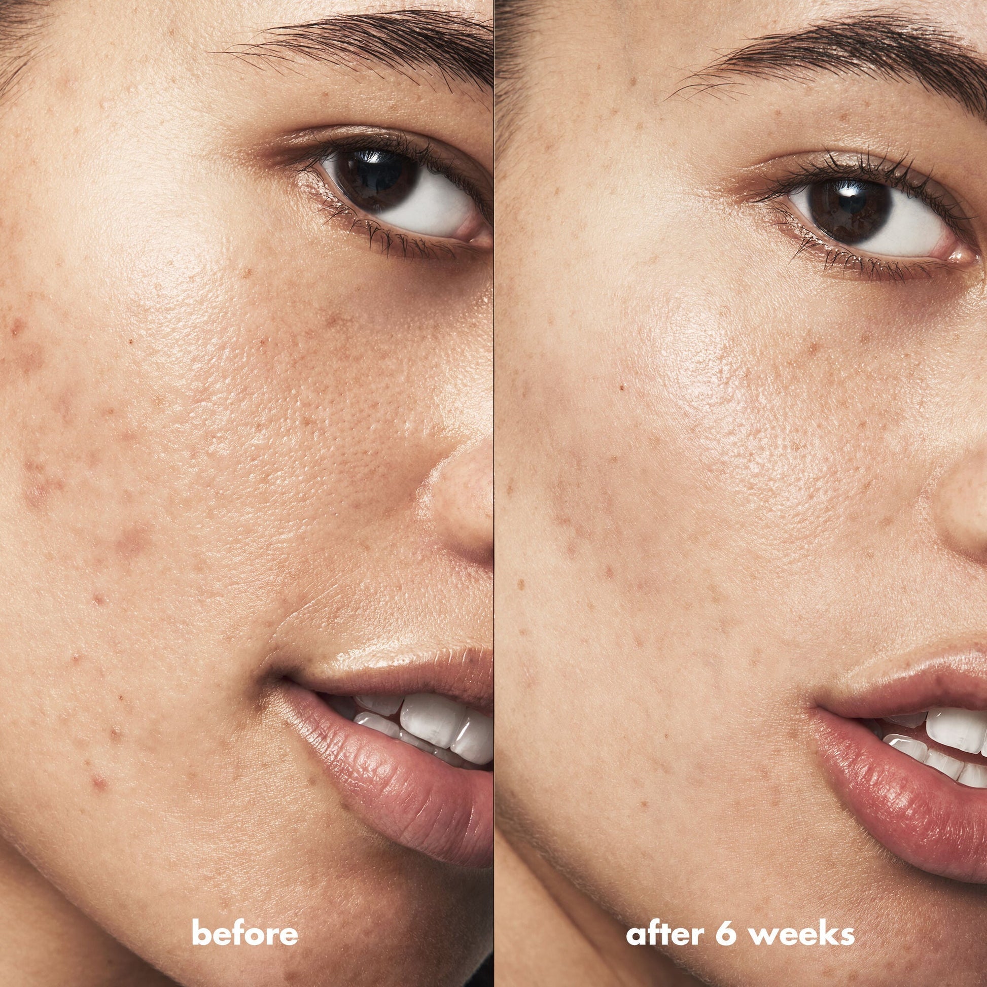 blemish-breakthrough-acne-calming-water-cream-f4 Acne_PDP_Isabella_Before_After_84ce713a-22d2-4bb9-aad7-445c7b27b1c9.jpg