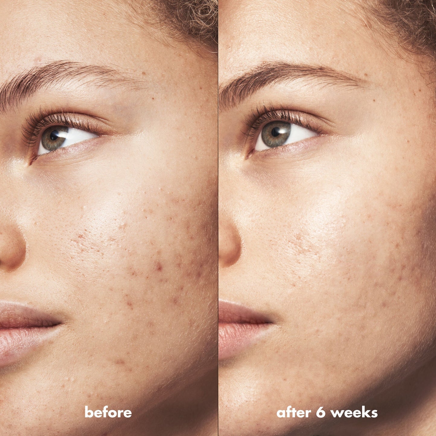 blemish-breakthrough-blemish-control-basics-kit-r4 Acne_PDP_Marley_Before_After_295728d2-6728-4f48-b8ef-c82bbca5b591.jpg